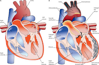 Coronary Heart Disease Treatment And Prevention.