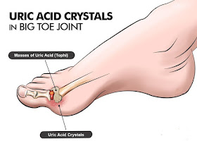 Natural Remedy For Uric Acid
