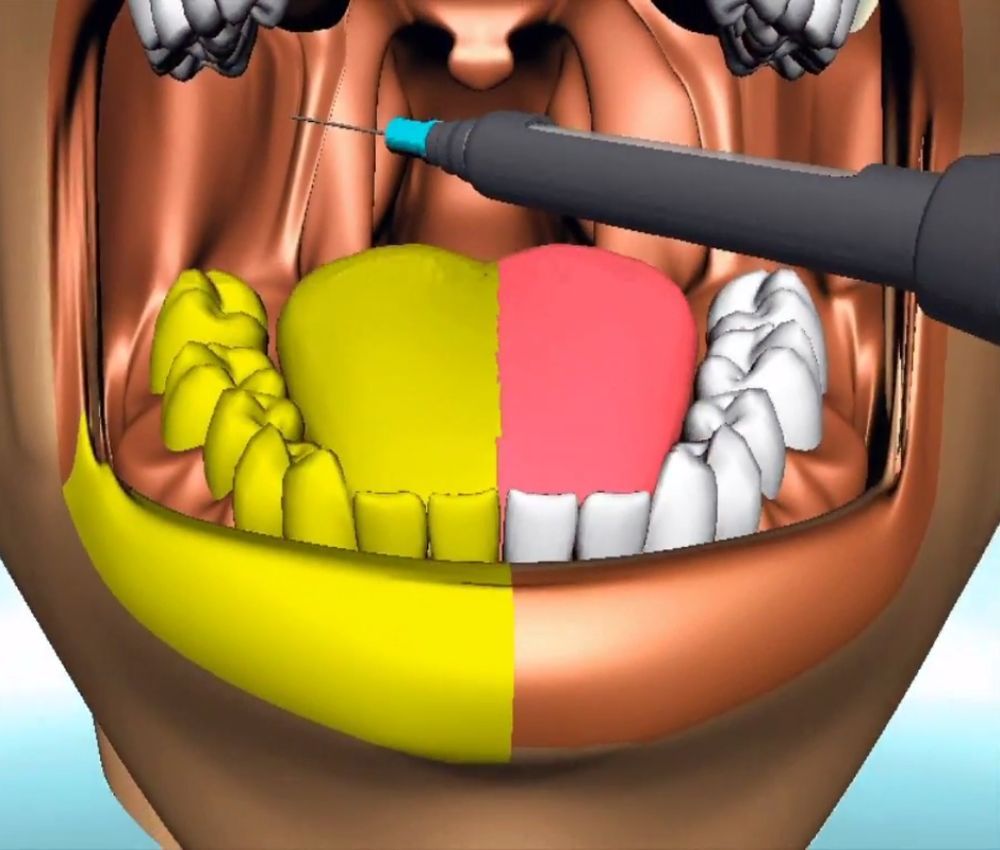 ANESTESIA DENTAL : Técnicas de anestesia troncular del maxilar inferior
