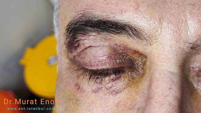 Complications in blepharoplasty - Eyelid hematoma