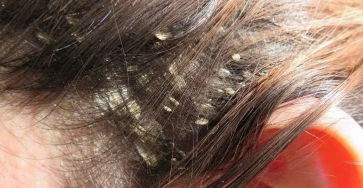 Get Rid Of Dandruff Naturally and Permanently 