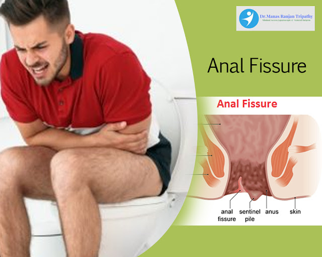 Fissures