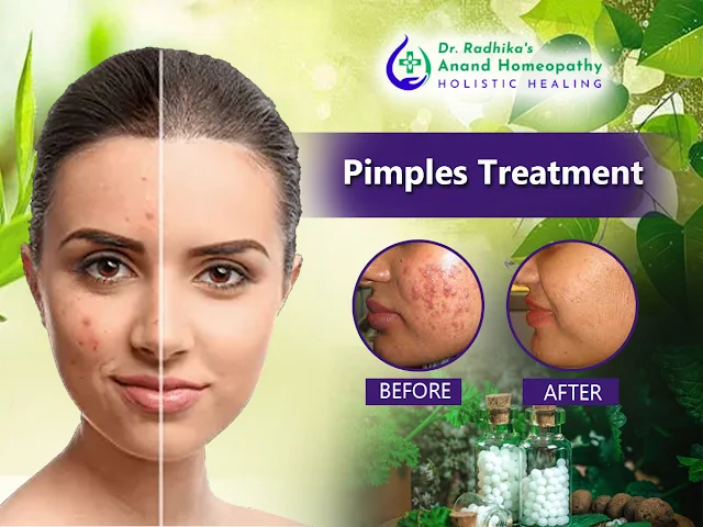 Pimples treatment