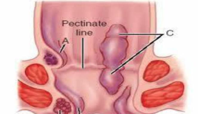 Obat Wasir Ambeien Paling Ampuh