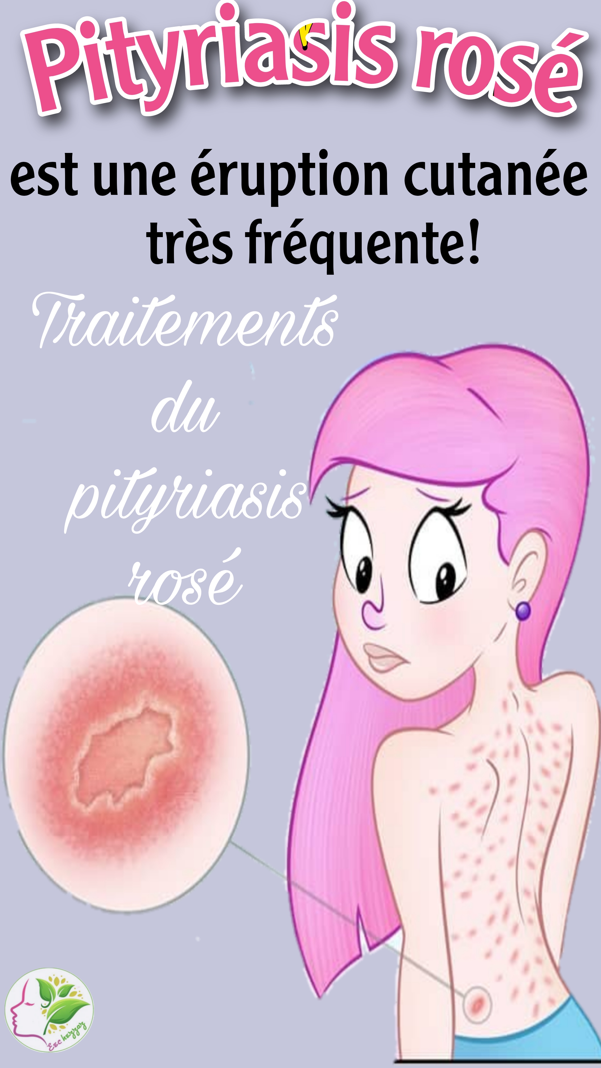 Pityriasis rosé est une éruption cutanée très fréquente! Traitements du pityriasis rosé