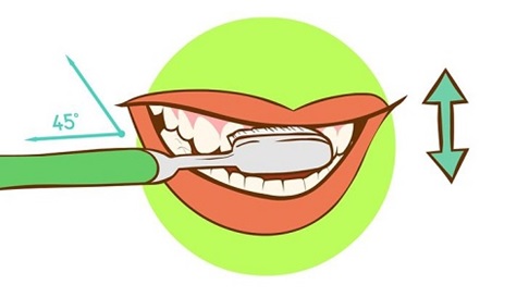 Đánh răng Implant khi đã phục hình răng sứ