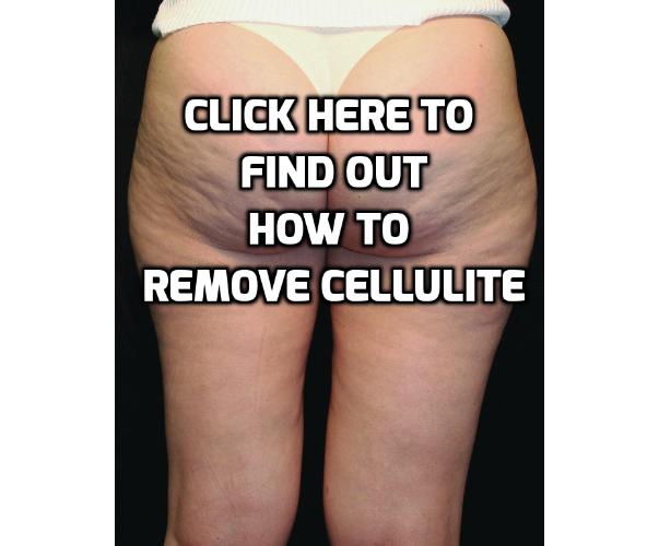 While cellulite can be very stubborn, you can remove cellulite with some lifestyle changes by exercising, having the right diet and also with some effective home cellulite treatment. Read on to find out more