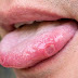 Coronavirus: 'COVID Tongue' Has Been Identified As A New Coronavirus Symptom, As Per Experts