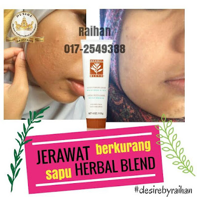 Testimoni krim herbal blend hilang jerawat