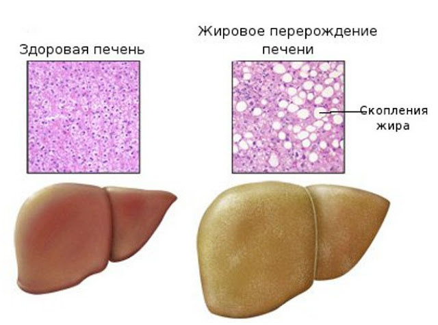 лептинорезистентность и жировая болезнь печени