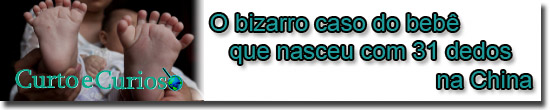 Bizarro caso do Bebe com 31 dedos China