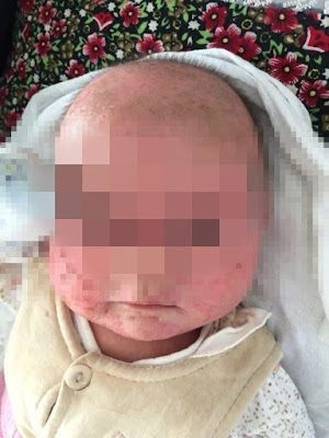 A mother leaves three-month-old baby son covered in blisters and cold sores all over the body after regularly kissing him on the lips. The baby was reportedly also running a high fever because of the infection that went untreated for days.