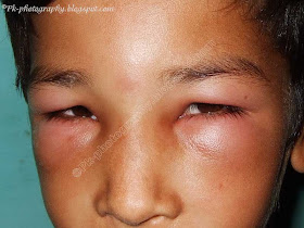 Wasp Sting Swelling Picture