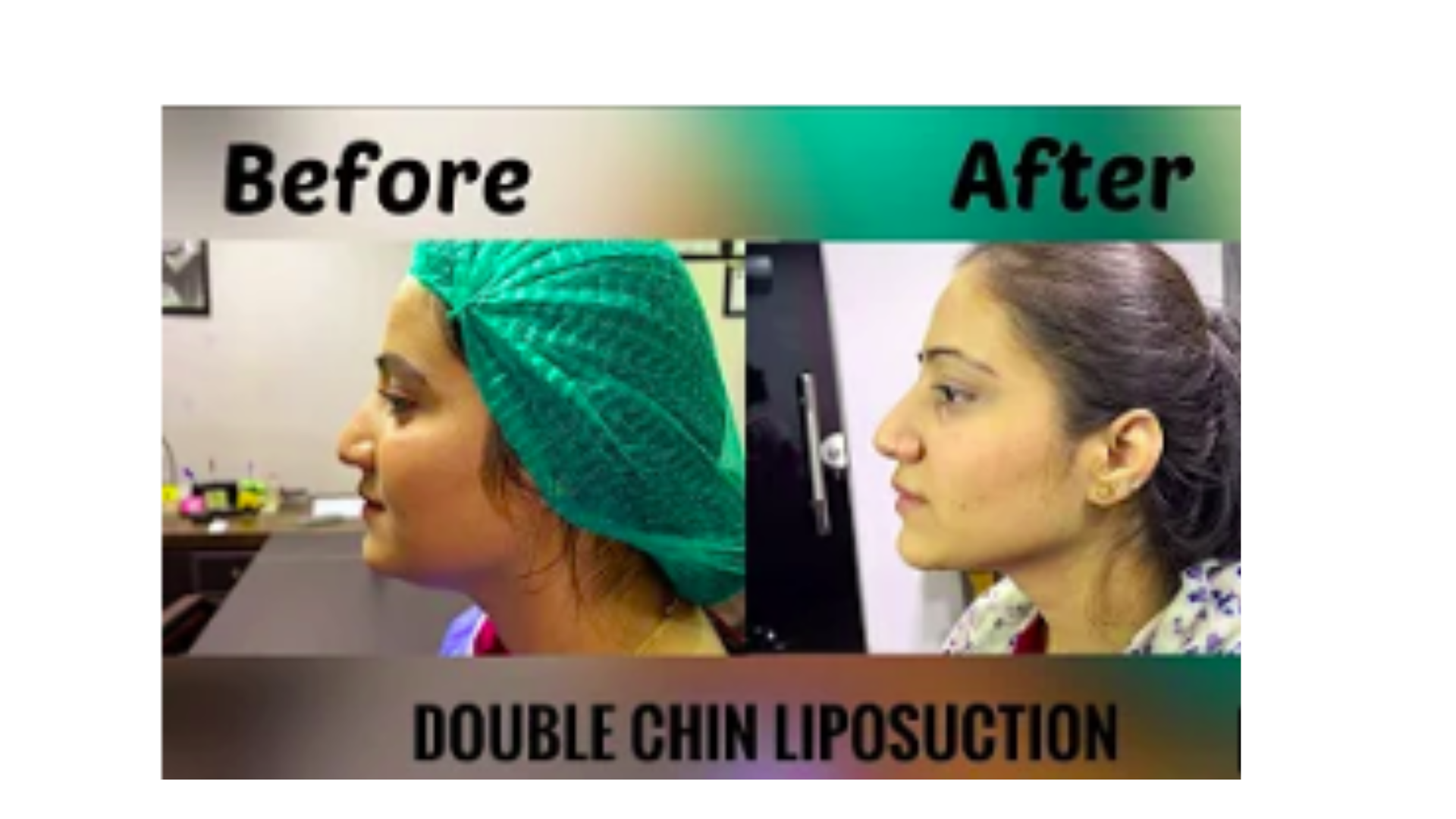 chin liposuction before and after