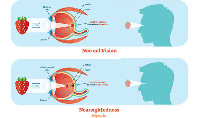 Myopia - All you wish to understand regarding shortsightedness