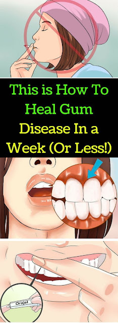 This is How To Heal Gum Disease In a Week (Or Less!)