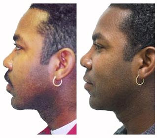 Rhinoplasty Before And After