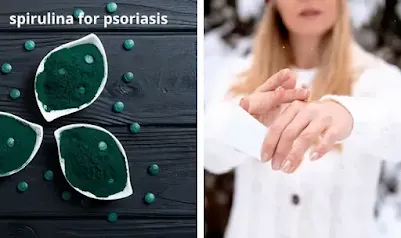 Benefits of spirulina for psoriasis