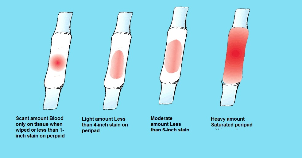 how heavy is implantation bleeding ? Known causes for ...