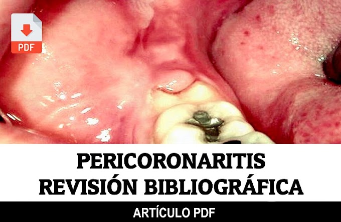 PDF: Pericoronaritis. Revisión bibliográfica