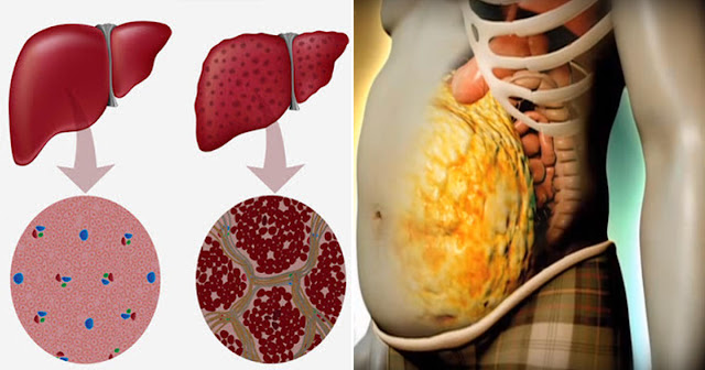 7 semne că ficatul tău are nevoie de o detoxifiere 