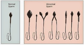 SPERMA BERMASALAH