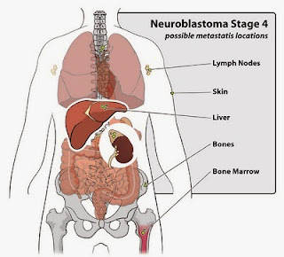 Terapi Non farmakologi Neuroblastoma
