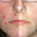 How to Get Rid of Pimples