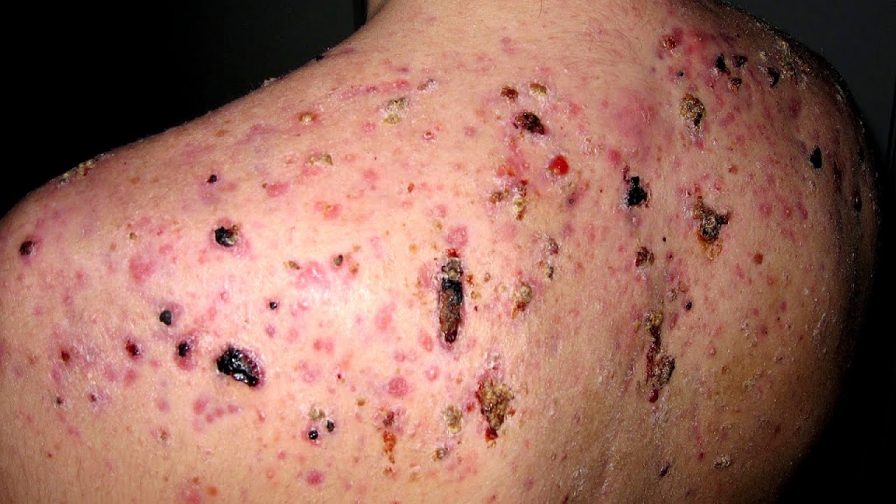 How To Get Rid Of Body Acne Fast