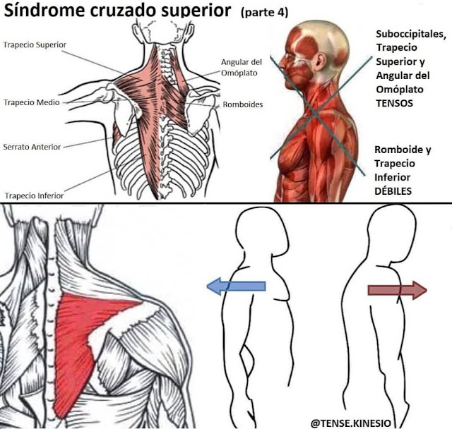 ☝️📸 SÍNDROME CRUZADO SUPERIOR ‼️🤯  (PARTE 4️⃣)