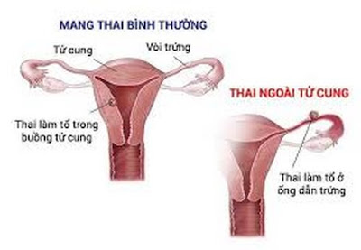 Cái thai nằm ngoài tử cung bật bí phá được khôn