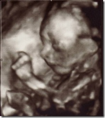 Face 1 at 20 Weeks