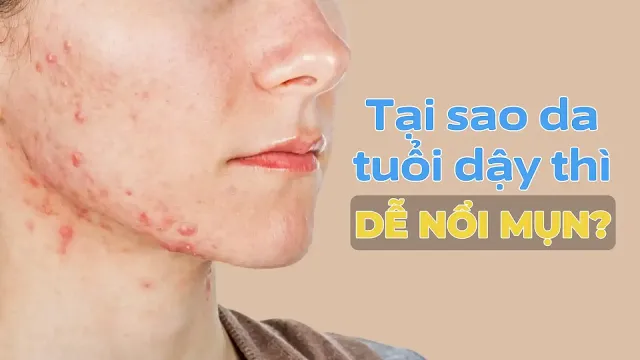 duong-da-cho-tuoi-day-thi