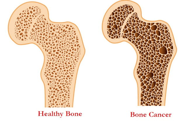 bone-cancer-what-is-it
