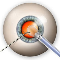 cataract surgery - eye care fashion