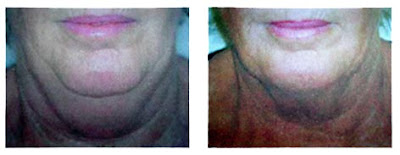 Mesotherapy Pictures