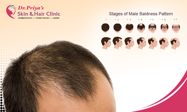 Best Male Pattern Baldness In Bangalore