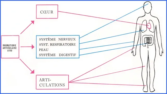 ACTH, RAA, antistreptolysine O, ankyloses, streptomycine,