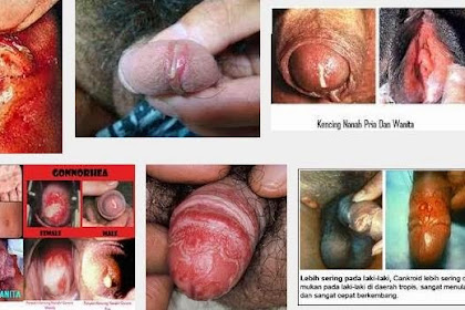 Kelamin Terasa Nyeri Saat Kencing Dan Perih