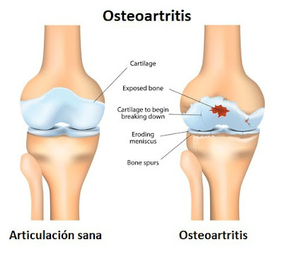 síntomas osteoartritis