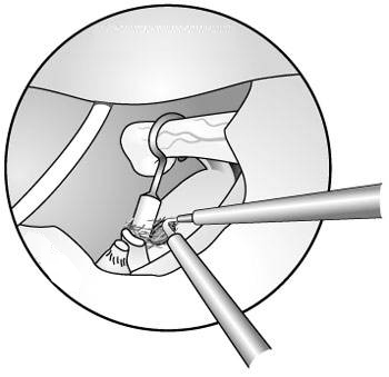 Preoperative and Postoperative Otosclerosis - Nursing Diagnosis