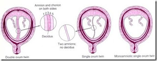  atau jikalau satu ovum yang sudah dibuahi mengalami pembelahan terlalu dini sehingga membent Kehamilan Kembar (Gemeli) pada Penyulit Persalinan