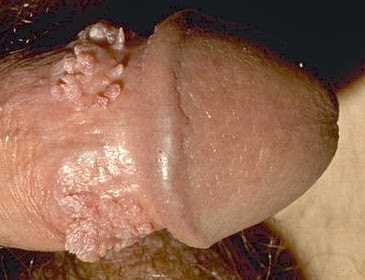 Penyebab Terinfeksi Virus Hpv