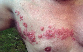 Herpes Zoster di dada Info Kesehatan Indonesia
