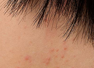 Eczema Causes, Symptoms ,Prevention