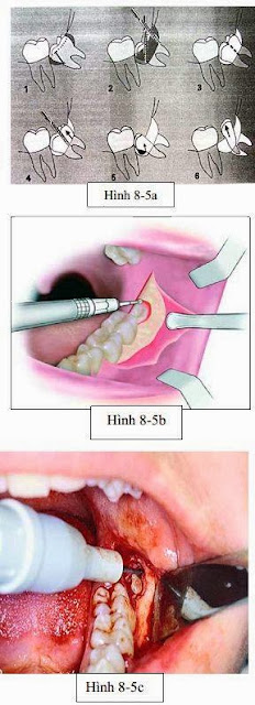 phẫu thuật răng 8
