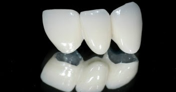 Bọc răng sứ với công nghệ phục hình cố định