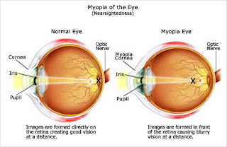miopia graus, causas da miopia, grau miopia maximo, grau miopia positivo ou negativo, quem tem miopia deve usar oculos o tempo todo, miopia tem cura, miopia e astigmatismo, miopia 8 graus, miopia e astigmatismo juntos