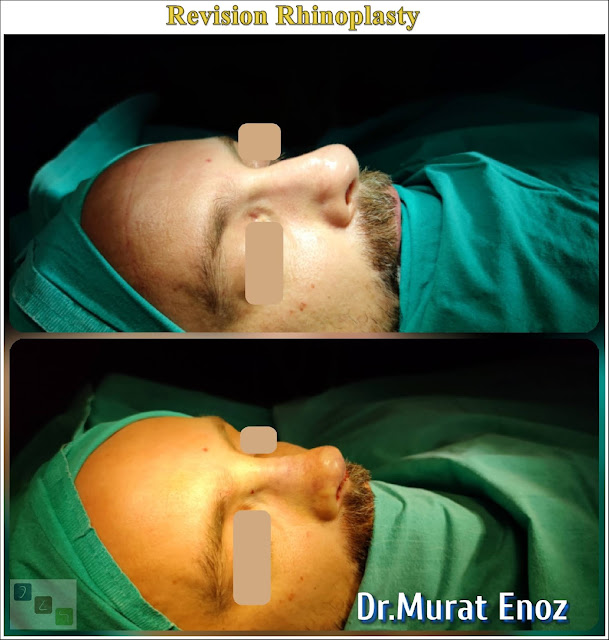 Revision Nose Aesthetic Operation in Istanbul,