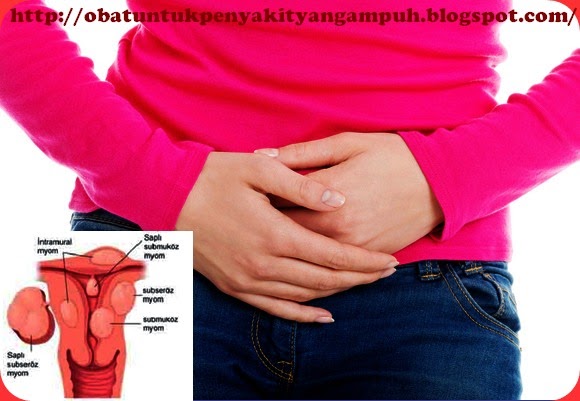 http://obatuntukpenyakityangampuh.blogspot.com/2015/02/obat-untuk-penyakit-miom.html